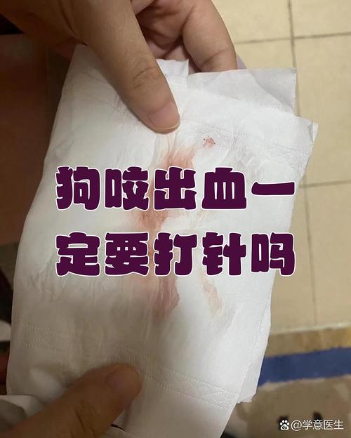 被家养的狗咬了出血要打针吗,狗咬伤流血要不要打疫苗?速去医院看医生! 被家养的狗咬了出血要打针吗,狗咬伤流血要不要打疫苗?速去医院看医生!