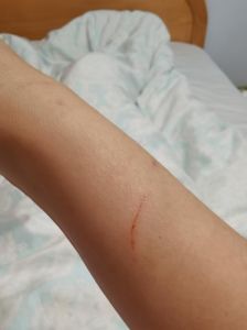 被家猫抓了，猫抓咬伤别大意，及时处理打疫苗